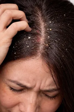 SHOP_BY_CONCERN_DANDRUFF__LAVELLE