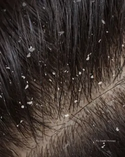SHOP_BY_CONCERN_DANDRUFF_CONTROL__BETEL BOTANICA