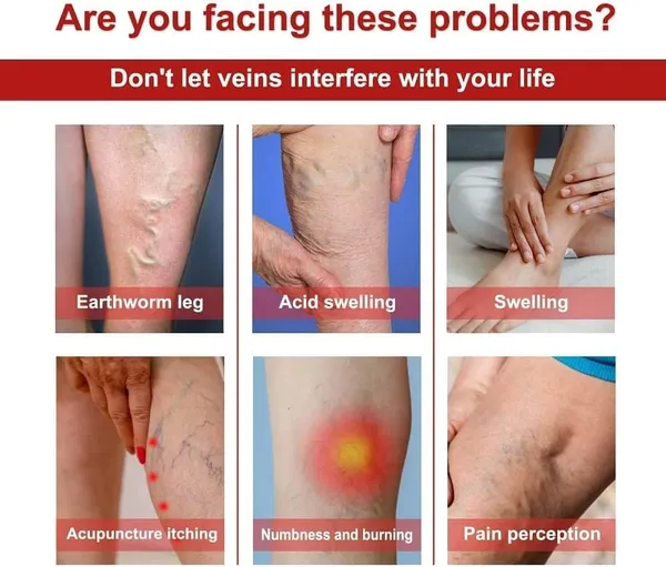 pack_of_2_Varicose_Veins_Patches_|_Herbal_Leg_Care_Patches_|_Relaxing_Cooling_Patches_for_Tired_Legs_|_Gentle_Daily_Use