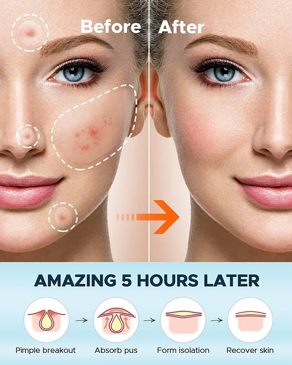 _Acne_Pimple_Patches_For_Face_-_72_Pcs_Invisible_Facial_Stickers_Cover_With_100%_Hydrocolloid_Dressing_Cover,_Effectively_Calms_&_Relieves_Acne,_Facial_Care,_Complete_Pimple_Remover