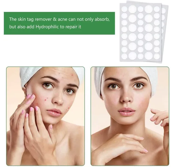 _Acne_Pimple_Patches_For_Face_-_72_Pcs_Invisible_Facial_Stickers_Cover_With_100%_Hydrocolloid_Dressing_Cover,_Effectively_Calms_&_Relieves_Acne,_Facial_Care,_Complete_Pimple_Remover