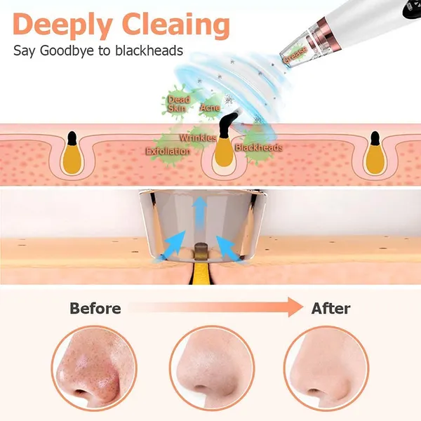 6_In_1_Derma_Section_Blackhead_Whitehead_Extractor_Blackhead_Remover_Acne_Pimple_Pore_Cleaner_Vacuum_Tools_-_Facial_Cleaner_Device_For_Nose_&_Skin_Care_Men_&_Woman_Pink
