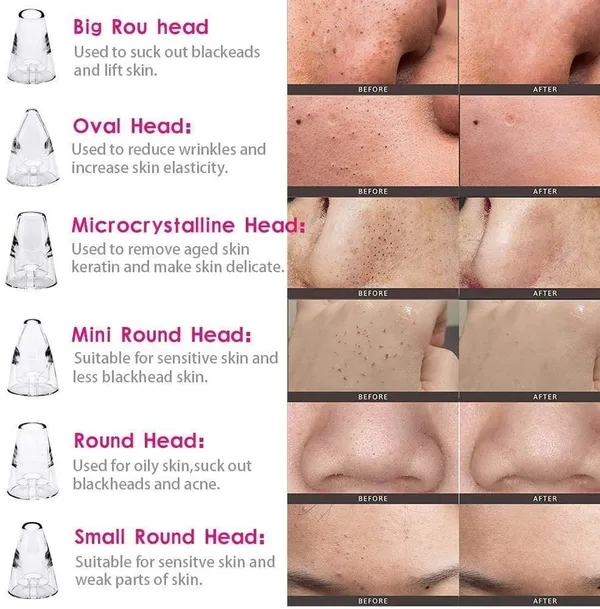 6_In_1_Derma_Section_Blackhead_Whitehead_Extractor_Blackhead_Remover_Acne_Pimple_Pore_Cleaner_Vacuum_Tools_-_Facial_Cleaner_Device_For_Nose_&_Skin_Care_Men_&_Woman_Pink
