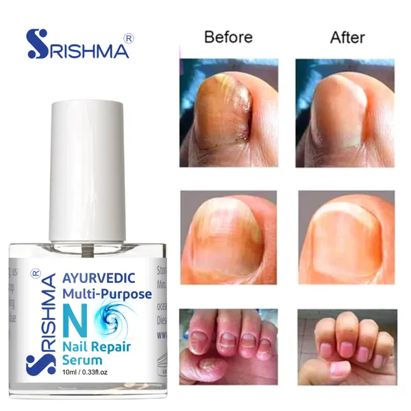 Nail_Repair_Serum_For_Stimulates_Nail_Growth,_For_Damaged_Skin_&_Thin_Nails_(100%_Natural)