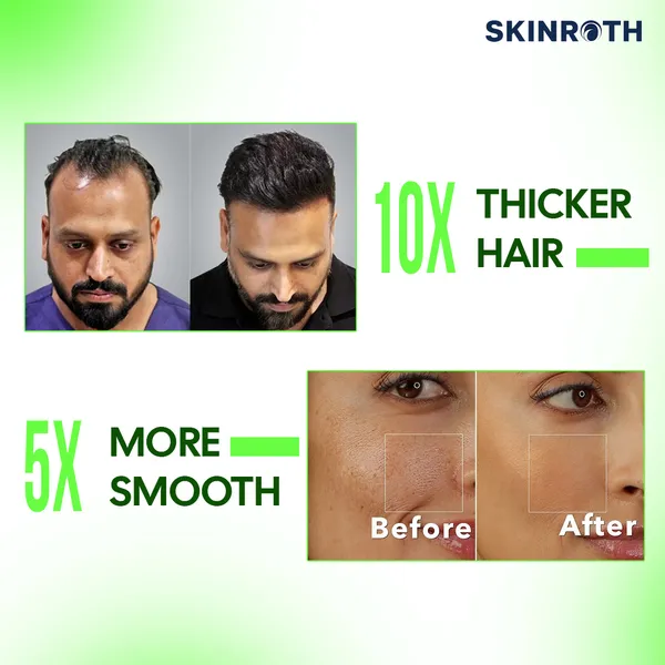 540_Microneedle_0.5Mm_Derma_Roller__Food-Grade_Stainless_Steel_Microneedling_Tool_For_Face_&_Beard_Care__Compact_Design_For_Skincare_&_Facial_Rejuvenation_Unisex