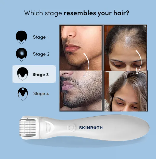 Titanium_Electric_Derma_Roller_0.5Mm__Replaceable_540_Microneedle_Head_With_Red_Light_Therapy__Boost_Hair_Growth_&_Rejuvenate_Skin__Fast_Result.