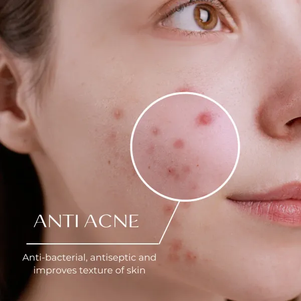 Anti_Acne_Soap_Bar