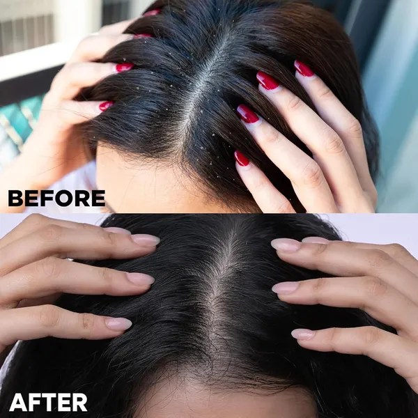 Shining_and_Smoothing_hair_Anti-Dandruff_Shampoo