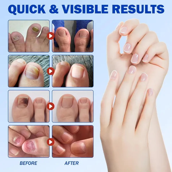 DNY_Nail_Patches_for_Toenails_|_21PCS_Hydrogel_Nail_Care_Patches_|_Overnight_Nail_Support_&_Protection_|Easy_to_Apply_for_Toenail_&_Fingernail_|_21PCS,Pack_Of_2