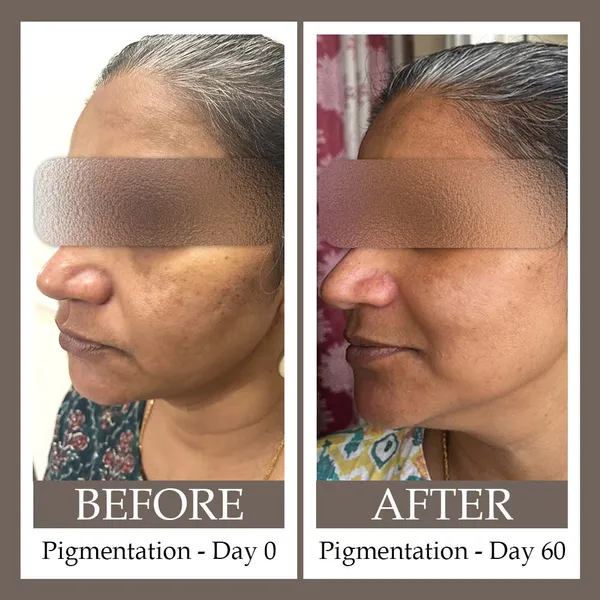Anti-Pigmentation_Face_Serum
