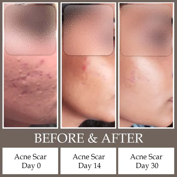 Acne_Scar_Control_Face_Serum