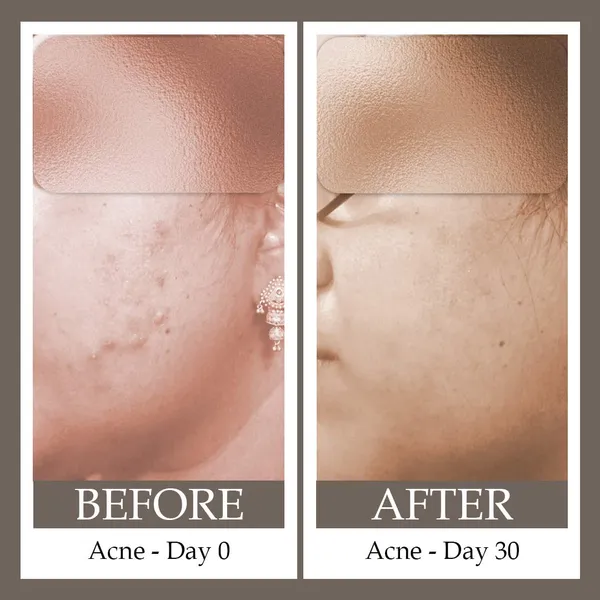 Acne_Control_Regime_-_Mild_To_Moderate_-_100ml+50ml