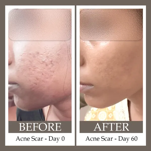 Acne_Scar_Reduction_Regime_-_Mild_To_Moderate_-_100ml+50ml