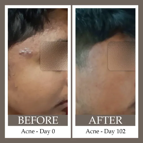ACNE_CONTROL_COMBO_PACK