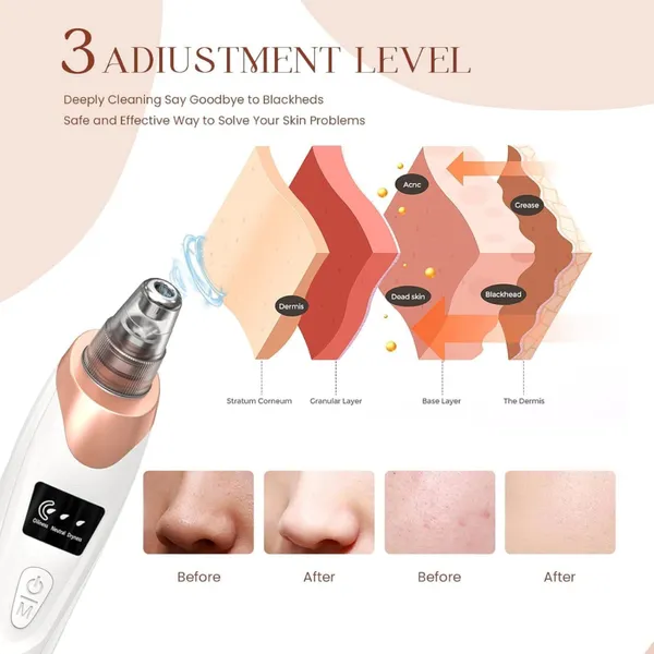 5-in-1_Blackhead_Remover_Machine_–_Electric_Pore_Cleaner_&_Whitehead_Removal_Tool,_Deep_Face_Cleaner_Machine_for_Acne,_Pimple_&_Blackhead_Removal,_USB_Rechargeable_Derma_Suction_Device