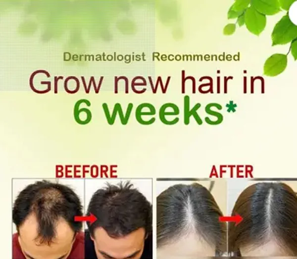 Queen__For_Anti_Hair_Fall,_Anti_Dandruff,_Long,_Healthy,_Nourished_Hair_Oil_For_Men_&_Women