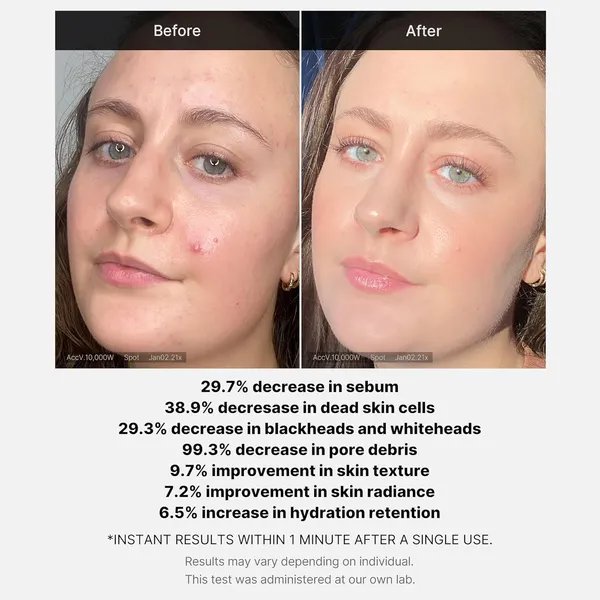 Medicube__Red_Acne_Succinic_Acid_Peel_40ml
