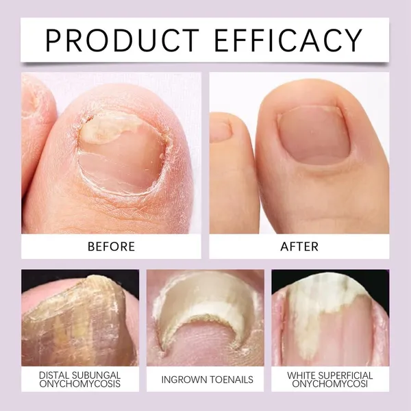 Bee_Venom_Nail_Treatment_Serum_|_🔥BUY_1_GET_1_FREE🔥