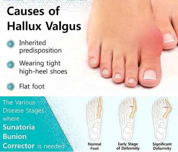 White_Toe_Separator_For_Feet_Toe_Spacers_Correct_Toes_Yoga_Silicone_Hammer_Toe_Corrector_For_Women_&_Men_Correct_Toe_Straighteners_For_Overlapping_Toes