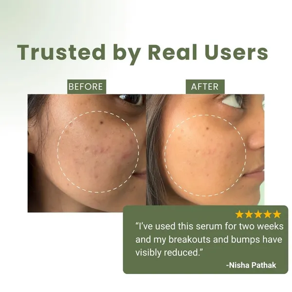 2%_Salicylic_Acid_Face_Serum_For_Acne,_Blackheads,_Uv_Damage_&_Dark_Spots_|Controls_Excess_Oil