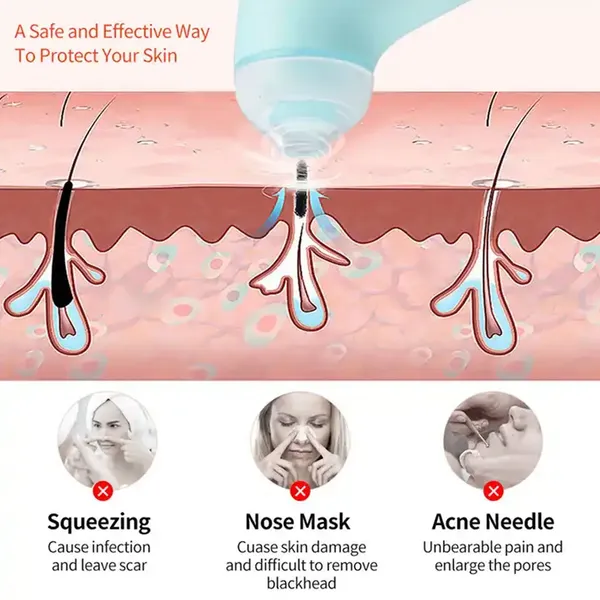 Genetelle_Vacuum_Blackhead_Remover_Machine