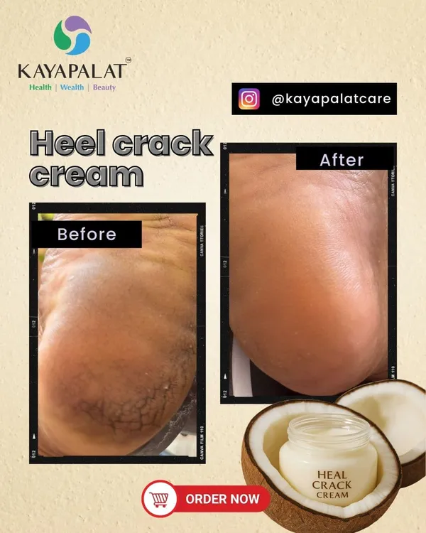 Heel_Crack_Cream_Ayurvedic_Heel_Repair_Cream_Softer_Heels_Repair_Dry_Hard_Cracked_Heels