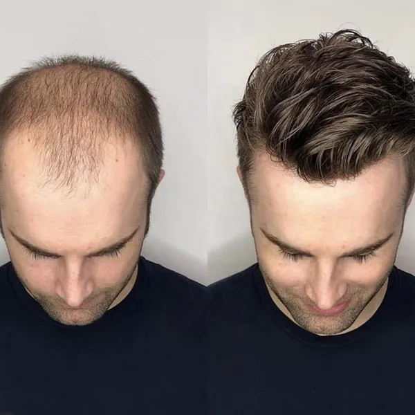 Men_S_Human_Hair_Replacement_System