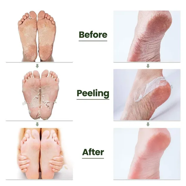 Pack_Of_2_-_Korean_Peeling_Exfoliating_Deep_Exfoliation_With_Glycolic_Acid_Removes_Dead_Skin_Cruelty_Free_Foot_Peel_Off_Mask_1_Pair_Lavender_Foot_Mask