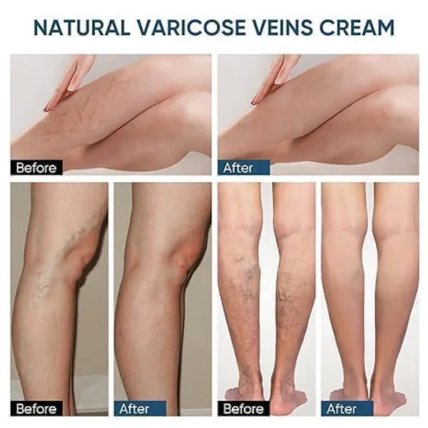 Varicose_Veins_Relief_Patches_30_Pcs_Pack_Of_3_Reduces_Swelling_Relieves_Pain_Improves_Blood_Circulation_Vein_Health_Herbal_Skin_Friendly_Instant_Pain_Relief_Pack_Of_2