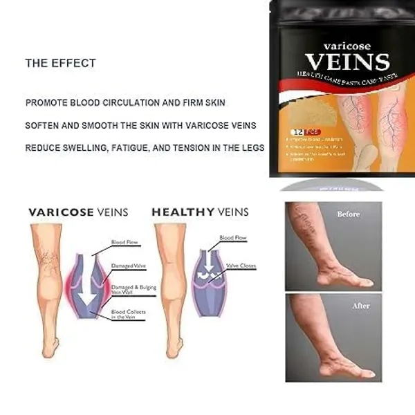 Varicose_Veins_Relief_Patches_30_Pcs_Pack_Of_3_Reduces_Swelling_Relieves_Pain_Improves_Blood_Circulation_Vein_Health_Herbal_Skin_Friendly_Instant_Pain_Relief_Pack_Of_2