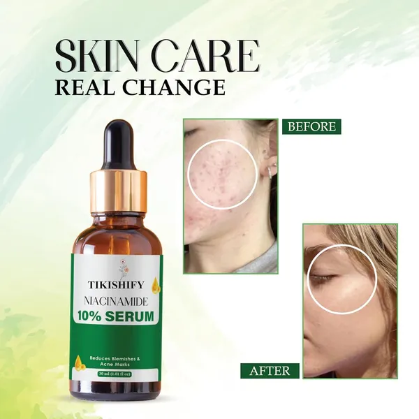 Niacinamide_10_Serum_Reduces_Blemishes_Acne_Marks_30Ml_1_01_Fl_Oz