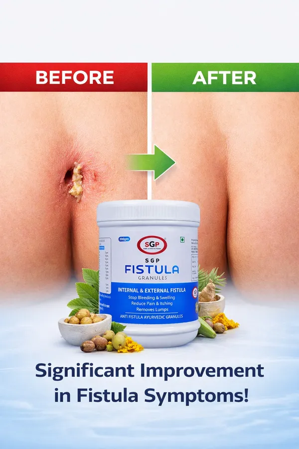Anti_Fistula_Ayurvedic_Granules_Stop_Bleeding_Swelling_Reduce_Pain_Itching_Removes_Lumps_200_Gram