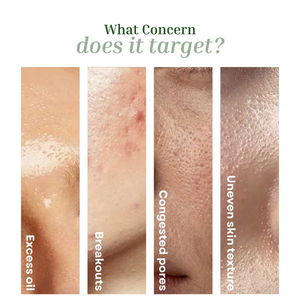 Clear_Balance_Face_Serum_Br_Br_Balances_Oil_Refines_Pores_Reduces_Breakouts_For_Oily_Combination_And_Acne_Prone_Skin_Sebum_Control_Reduces_Acne_20g_20g_0_71oz