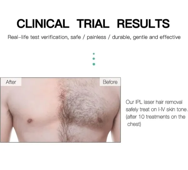 Permanent_Laser_Body_Hair_Remover