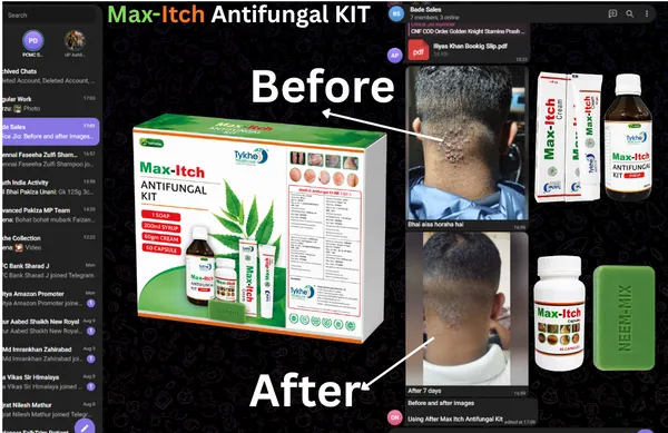 MaxItch_Antifungal_KIT_–_200ml_Syrup_+_60gm_Cream_+_60_Capsules_+_Neem-Mix_Soap_for_Itching_&_Fungal_Skin_Care
