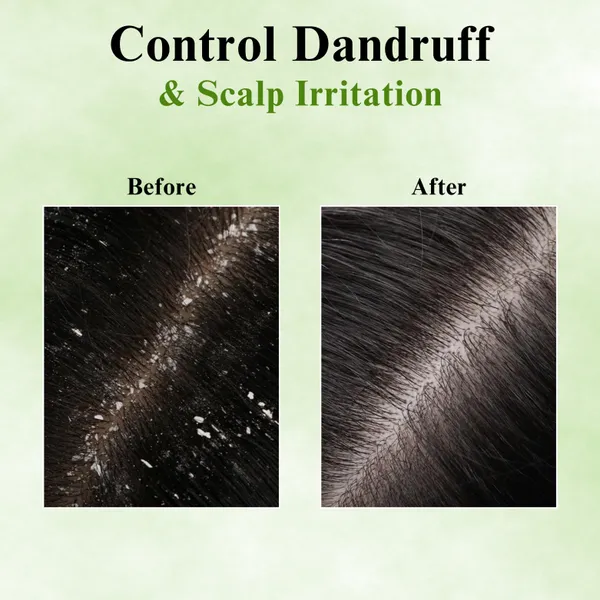 Blomera_Care_Dandruff_Defence_Hair_Oil_-_100ml