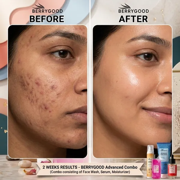 ACNE_PROTECTION_COMBO_(PACK_OF_4)