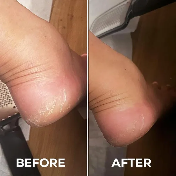 Foot_Peel_Mask_For_Women_And_Men_|_Peeling_And_Exfoliating_Foot_Mask_For_Dry_Cracked_Feet,_Removes_Dead_Skin_And_Calluses,_Hydrates_And_Smooths_Cracked_Heels_(Pack_Of_1)