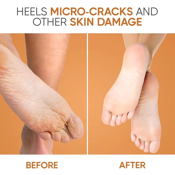 Foot_Repair_Cream_For_Rough,_Dry_And_Cracked_Heel_Feet,_20%_Urea_Cracked_Heel_Repair_Balm_Stick_40G,_Helps_Repair_And_Moisturise_Knees,_Elbows,_Hands_|_Benefits_Of_Shea_Butter_And_Vitamin_E