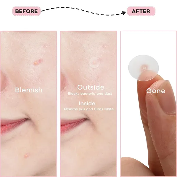 Pro_Micro_Darts_Tag_Gone_Skin_Patches_|_Natural_Nano_Pimple_Plasters_With_Microdart_Technology,_Acne_Spot_Treatment_Patches_For_All_Skin_Types_(4_Sheets)