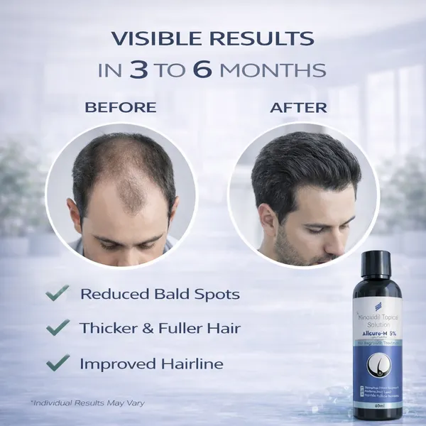 Allcure-M_5%_Minoxidil_Topical_Solution_For_Hair_Regrowth_-_60Ml