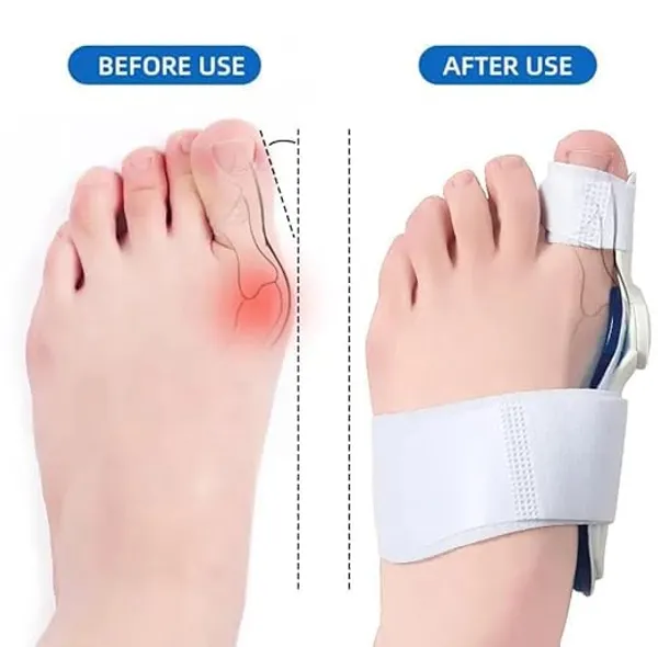 Silicone_Bunion_Splint_Toe_Straightener_For_Women_Men_Soft_Gel_Big_Toe_Alignment_Separator_Orthotic_Foot_Support_For_Hallux_Valgus_Care_Comfortable_Daily_Wear_Pack_Of_2