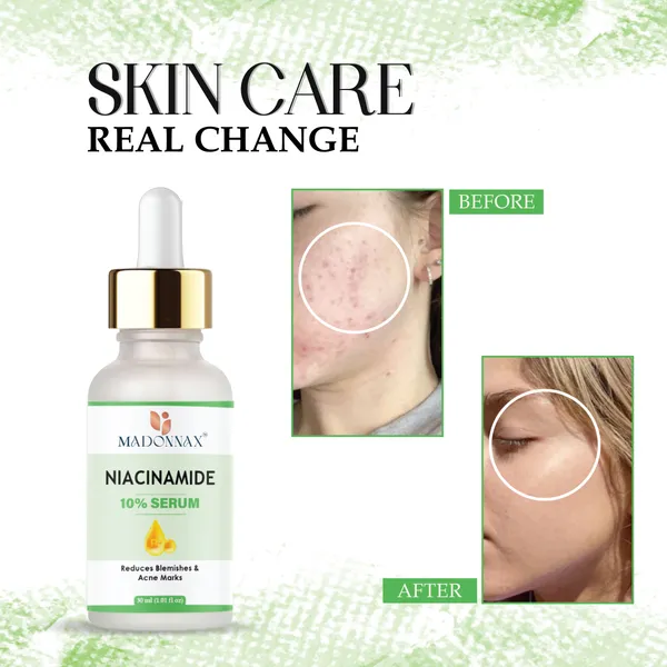 Madonnax_Niacinamide_10%_Pore_Minimising_Blemish_Reduction_Face_Serum_30Ml