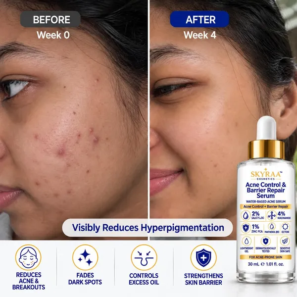 Acne_Control_Barrier_Repair_Serum_2_Salicylic_Acid_4_Niacinamide_1_Zinc_Pca_Panthenol_B5_Ectoin_Acne_Marks_Excess_Oil_Barrier_Support_Lightweight_Water_Based_Face_Serum_30_Ml