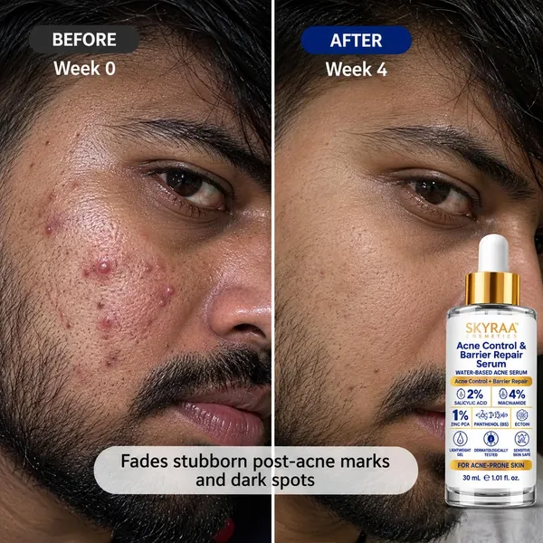 Acne_Control_Barrier_Repair_Serum_2_Salicylic_Acid_4_Niacinamide_1_Zinc_Pca_Panthenol_B5_Ectoin_Acne_Marks_Excess_Oil_Barrier_Support_Lightweight_Water_Based_Face_Serum_30_Ml