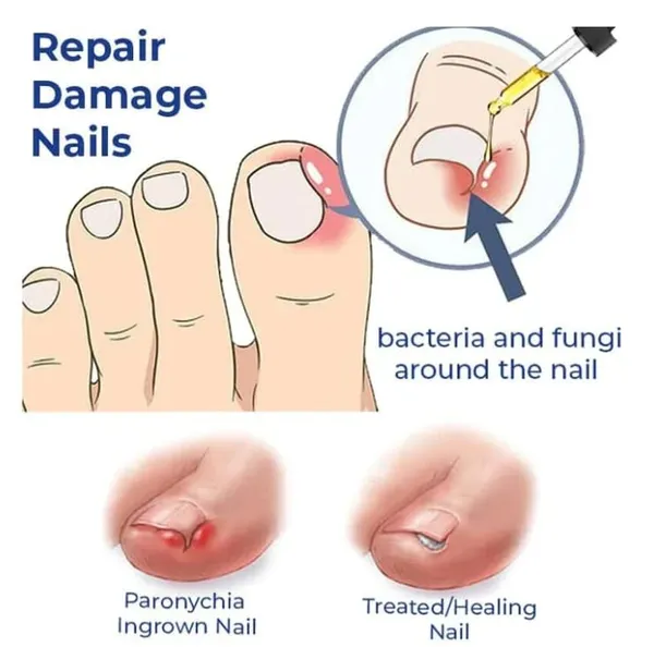 Anti_Paronychia_Relief_Oil,_10Ml,_Natural_Nail_Treatment_For_Pain_Relief_And_Disinfection