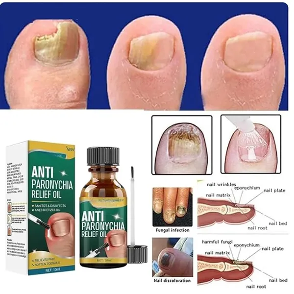 Anti_Paronychia_Relief_Oil,_10Ml,_Natural_Nail_Treatment_For_Pain_Relief_And_Disinfection