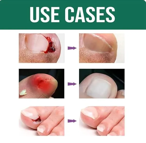 Anti_Paronychia_Relief_Oil,_10Ml,_Natural_Nail_Treatment_For_Pain_Relief_And_Disinfection