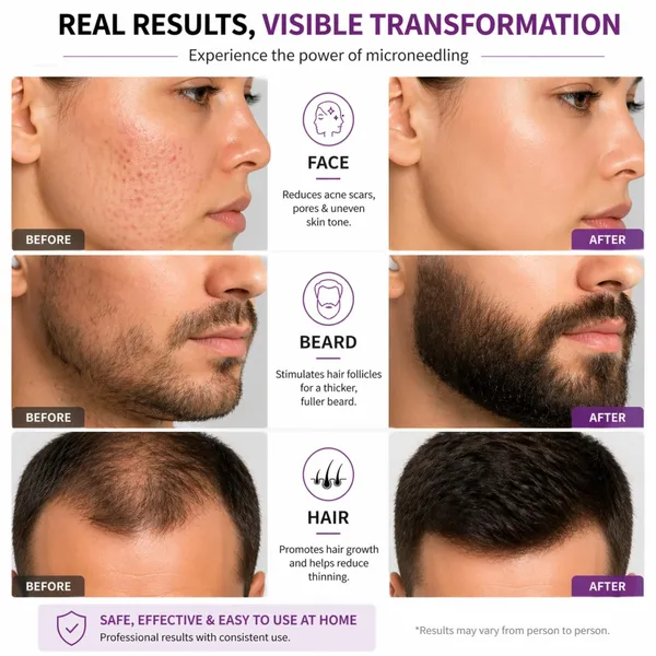 Professional_Derma_Roller_For_Face_And_Beard_Scalp_Thearpy_Roller_Beard_Growth_Kit_That_Promotes_Hair_Growth_Improves_Skin_Texture_And_Works_As_A_Facial_Derma_Roller_For_Glowing_Skin_0_5mm_540_Titanium_Microneedles