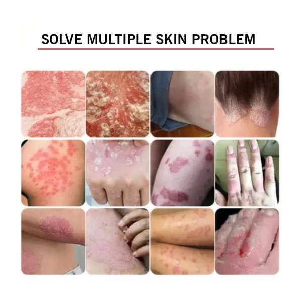 Jivtara_Ayurvedic_Antifungal_Therapy_Balm_Neem_And_Turmeric